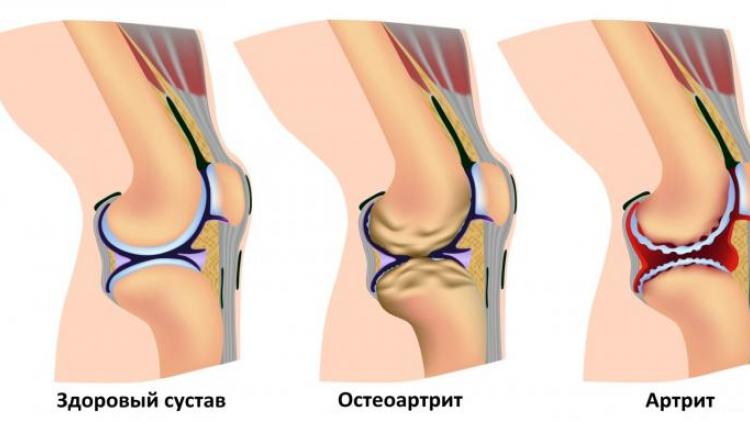 Поражение суставов