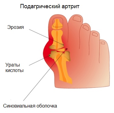 Подагра
