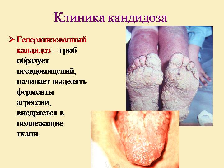 Генерализованный кандидоз