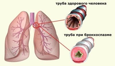 Бронхоспазм