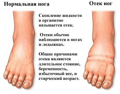Периферические отеки