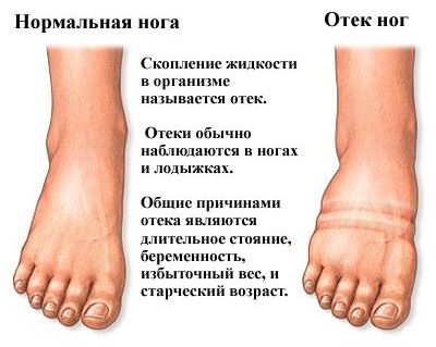 Периферические отеки