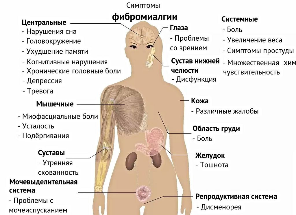 Фибромиалгия