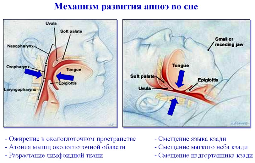 Синдром апноэ