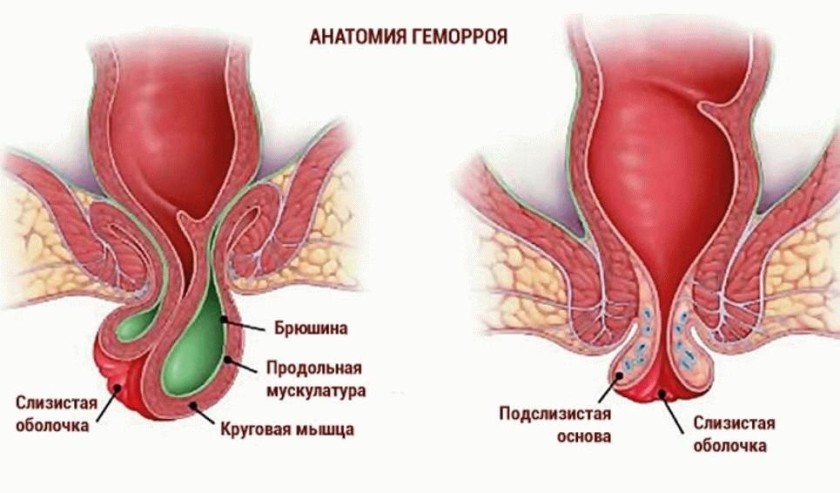 Геморрой