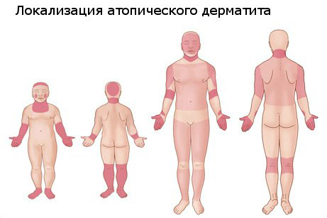 Атопический дерматит