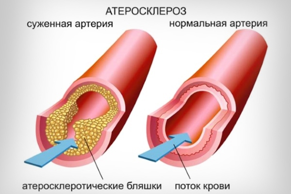 Атеросклероз