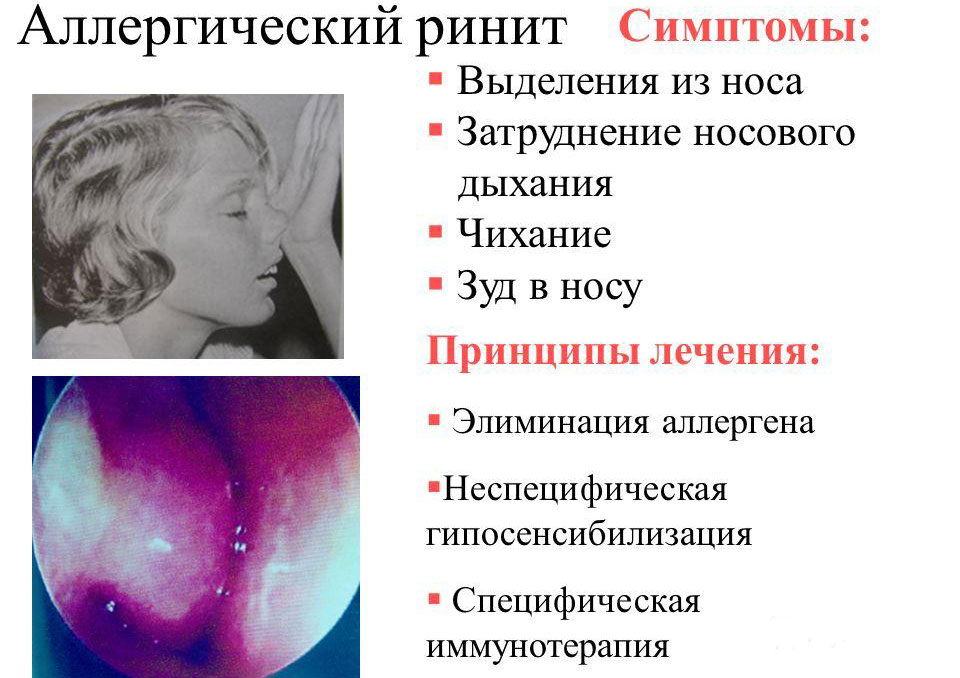 Аллергический ринит