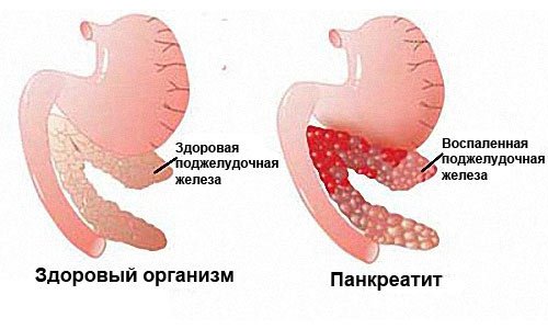 Острый панкреатит
