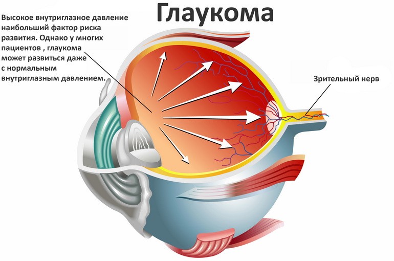 Глаукома