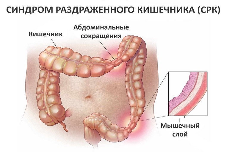 Синдром раздраженного кишечника;
