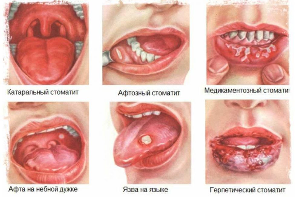 Виды стоматита