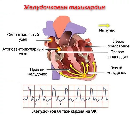 Тахикардия
