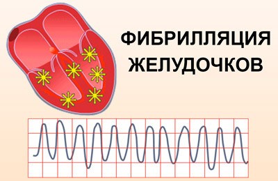 Фибрилляция желудочков