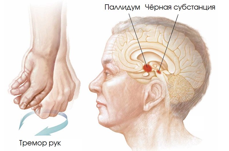 Болезнь Паркинсона