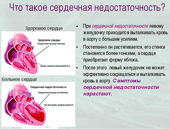 Сердечная недостаточность
