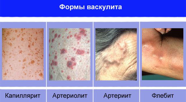 Виды васкулитов
