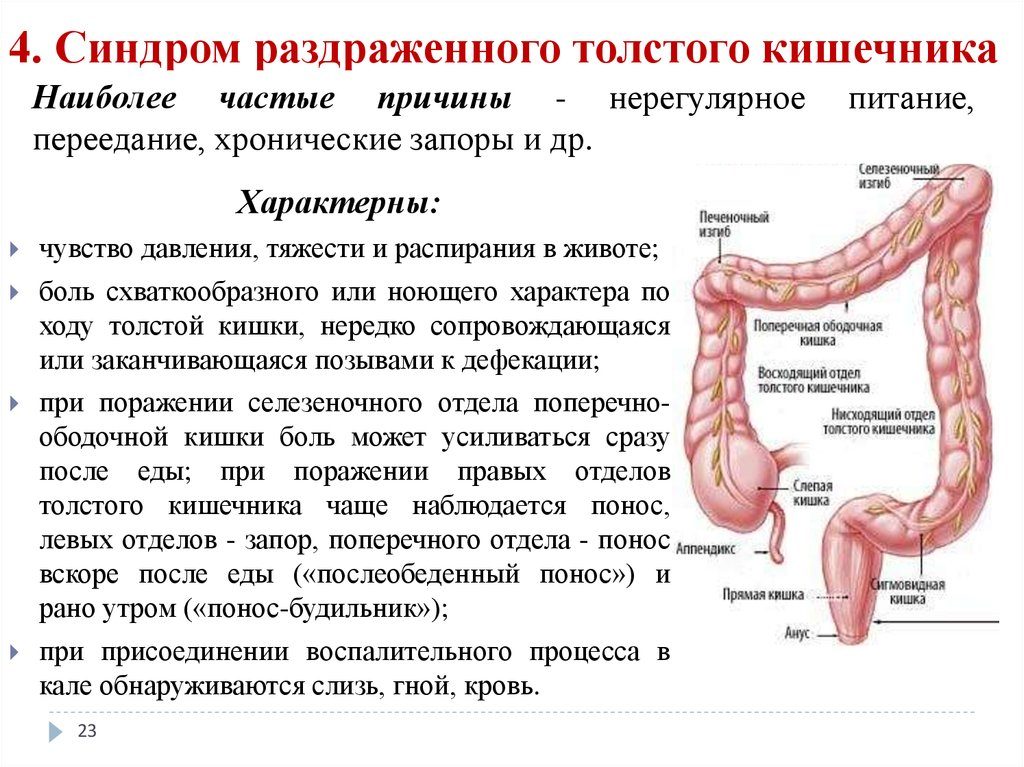 Cиндром раздраженного кишечника