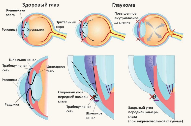 Закрытоугольная глаукома