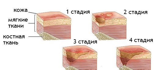 Трофическая язва