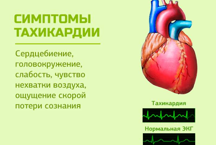 Тахикардия