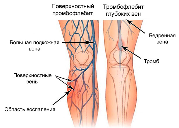 Тромбофлебит
