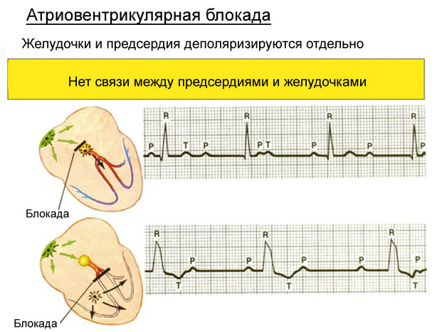 Атриовентрикулярная блокада