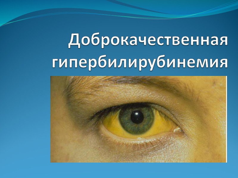 Гипербилирубинемия
