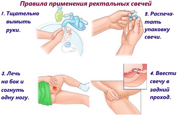 Техника ввода ректальных свечей