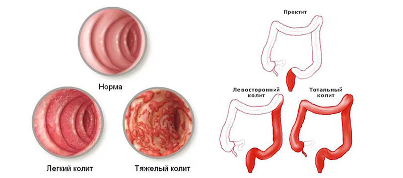 Колит