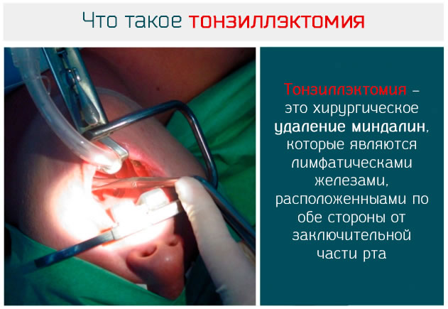 Тонзиллэктомия