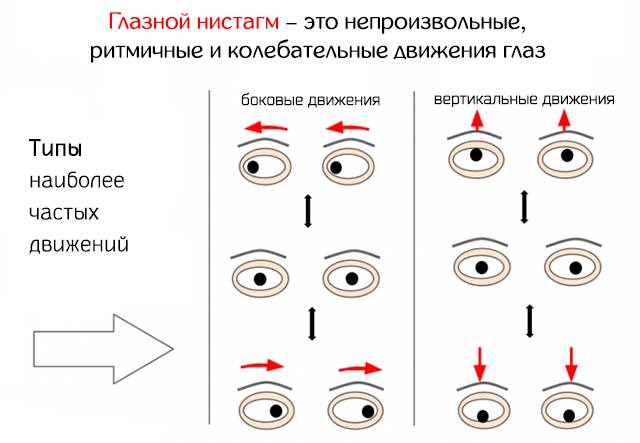 Нистагм