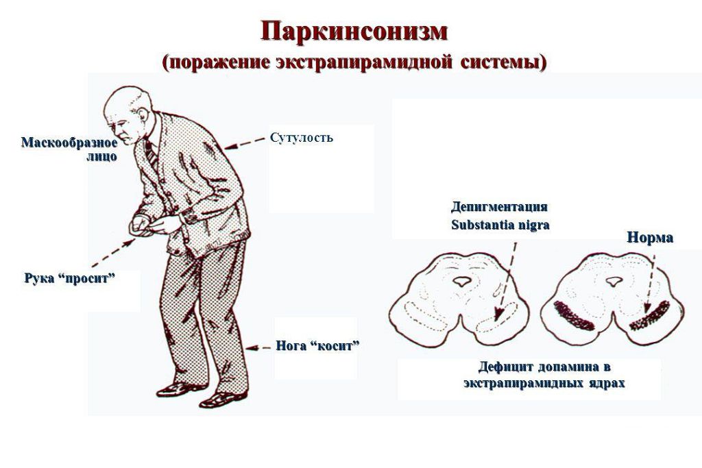 Симптомы болезни Паркинсона