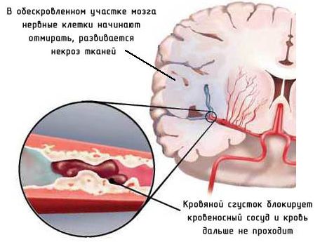Ишемический инсульт