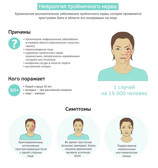 Невралгия тройничного нерва