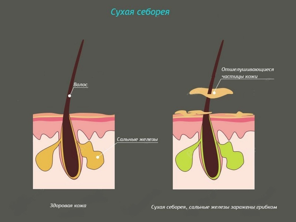 Себорея