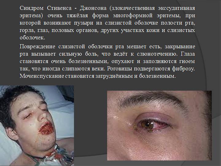 Синдром Стивенса-Джонсона