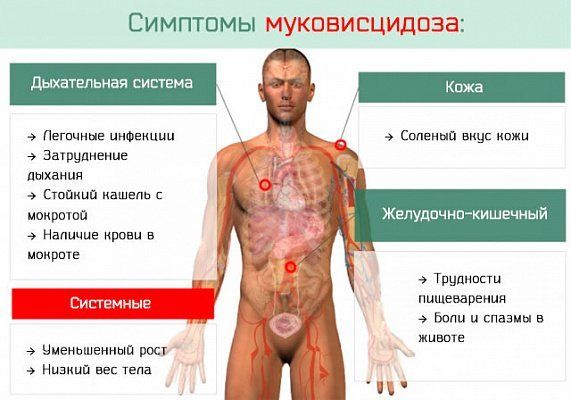 Муковисцидоз
