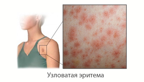 Эритема