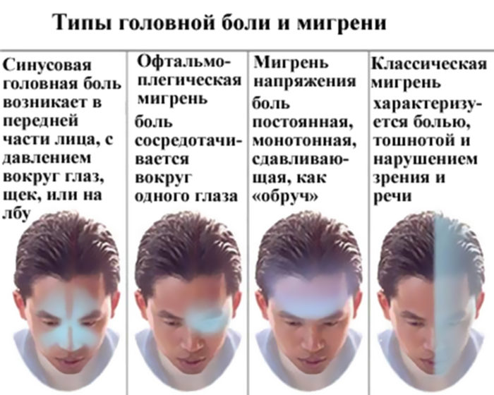Виды головной боли