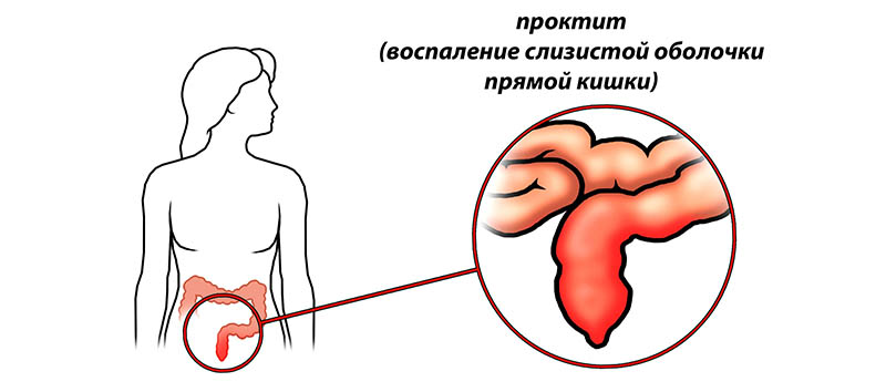 Проктит