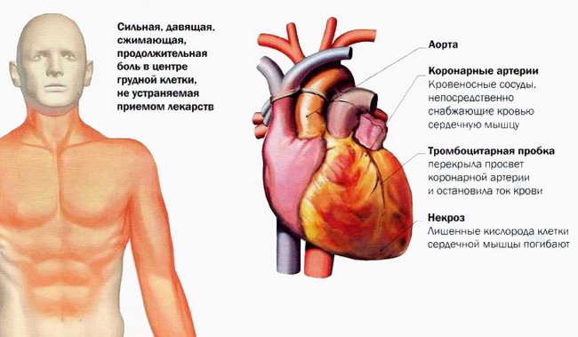 Инфаркт миокарда
