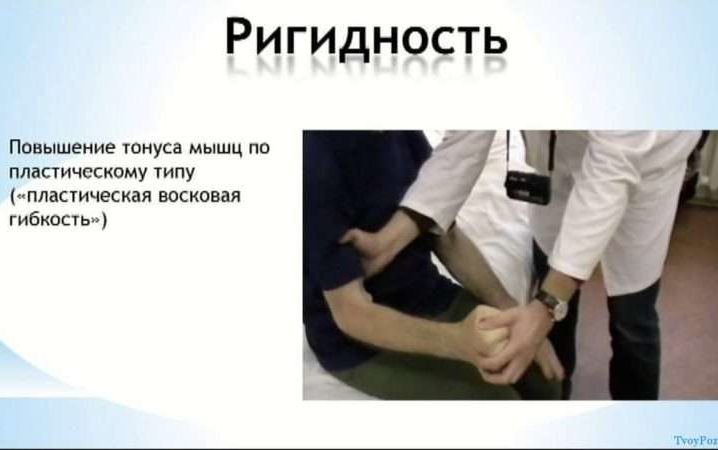 Ригидность мышц