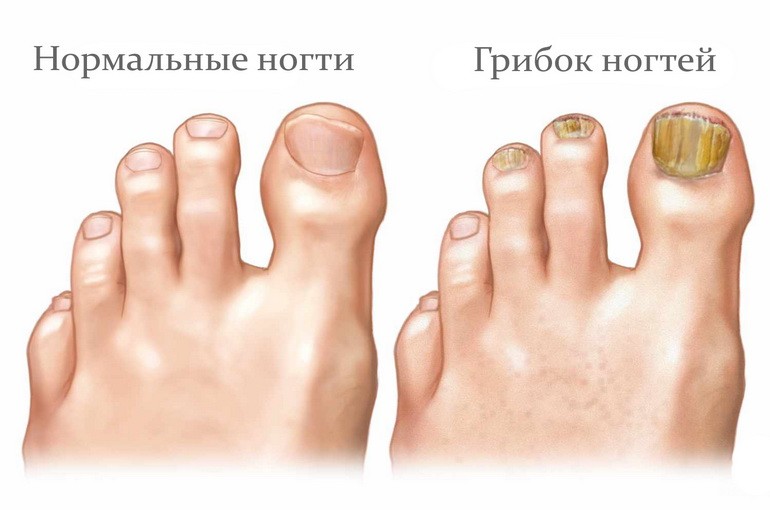 Онихомикоз