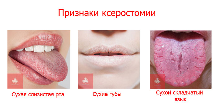Ксеростомия