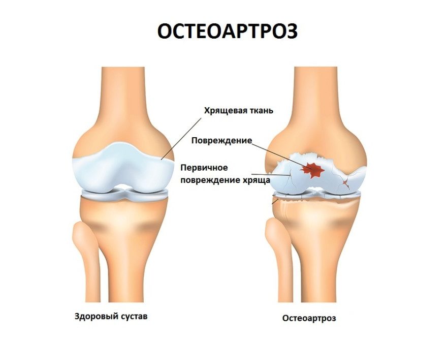 Остеоартроз