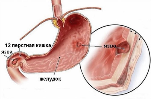 Язва желудка