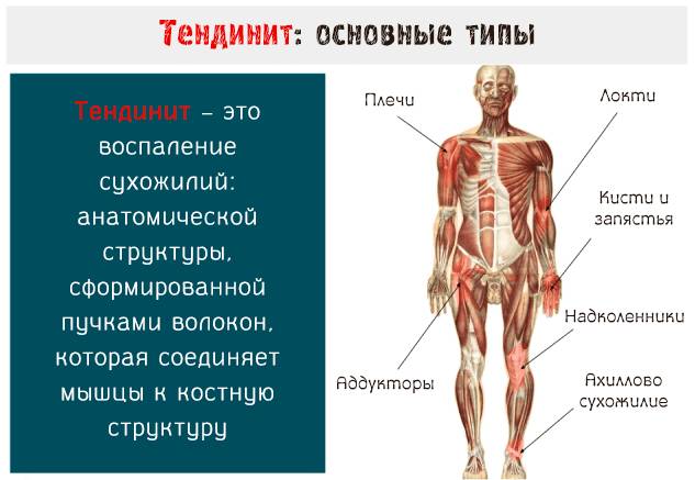 Тендинит