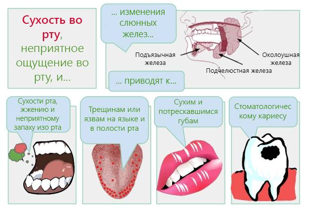 Ксеростомия