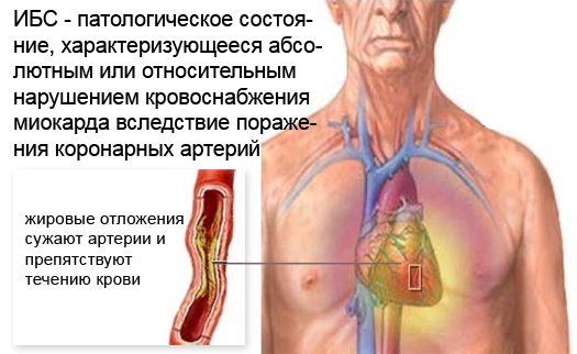 Ишемическая болезнь сердца